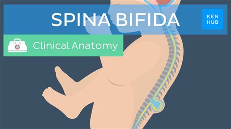 bufuda|Spina bifida causes, symptoms and treatment